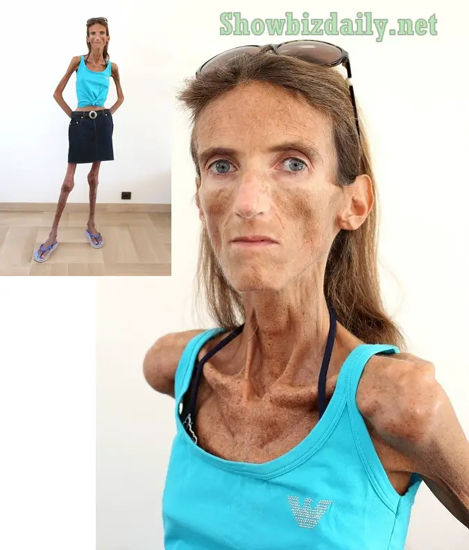 Valeria Levitin Extremely Anorexic Model And Thinnest Woman In The